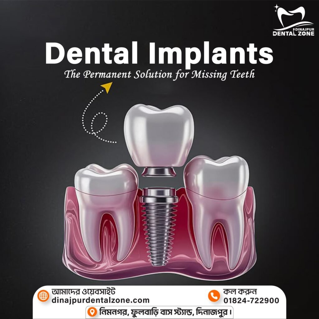 dental implant procedure in dinajpur by dr. monjur alam – dinajpur dental zone