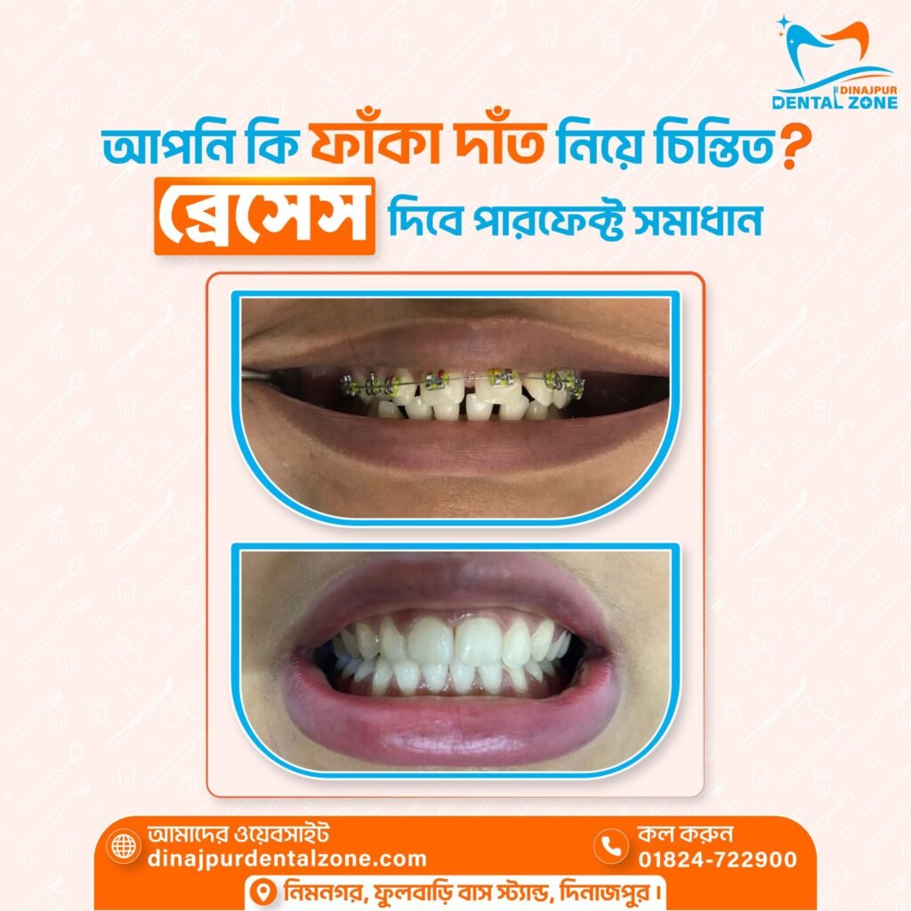 orthodontic braces treatment in dinajpur by dr. monjur alam – dinajpur dental zone