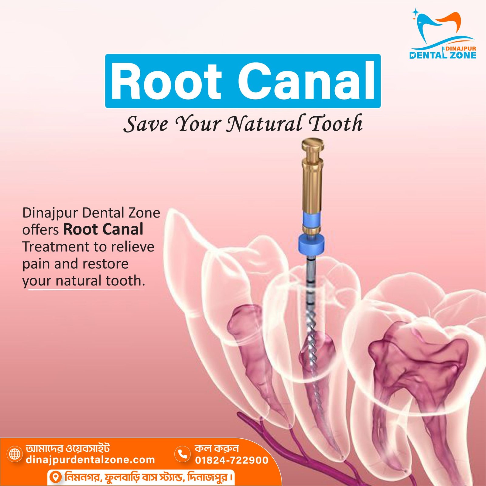 Single visit root canal in Dinajpur by Dr. Monjur Alam – Dinajpur Dental Zone