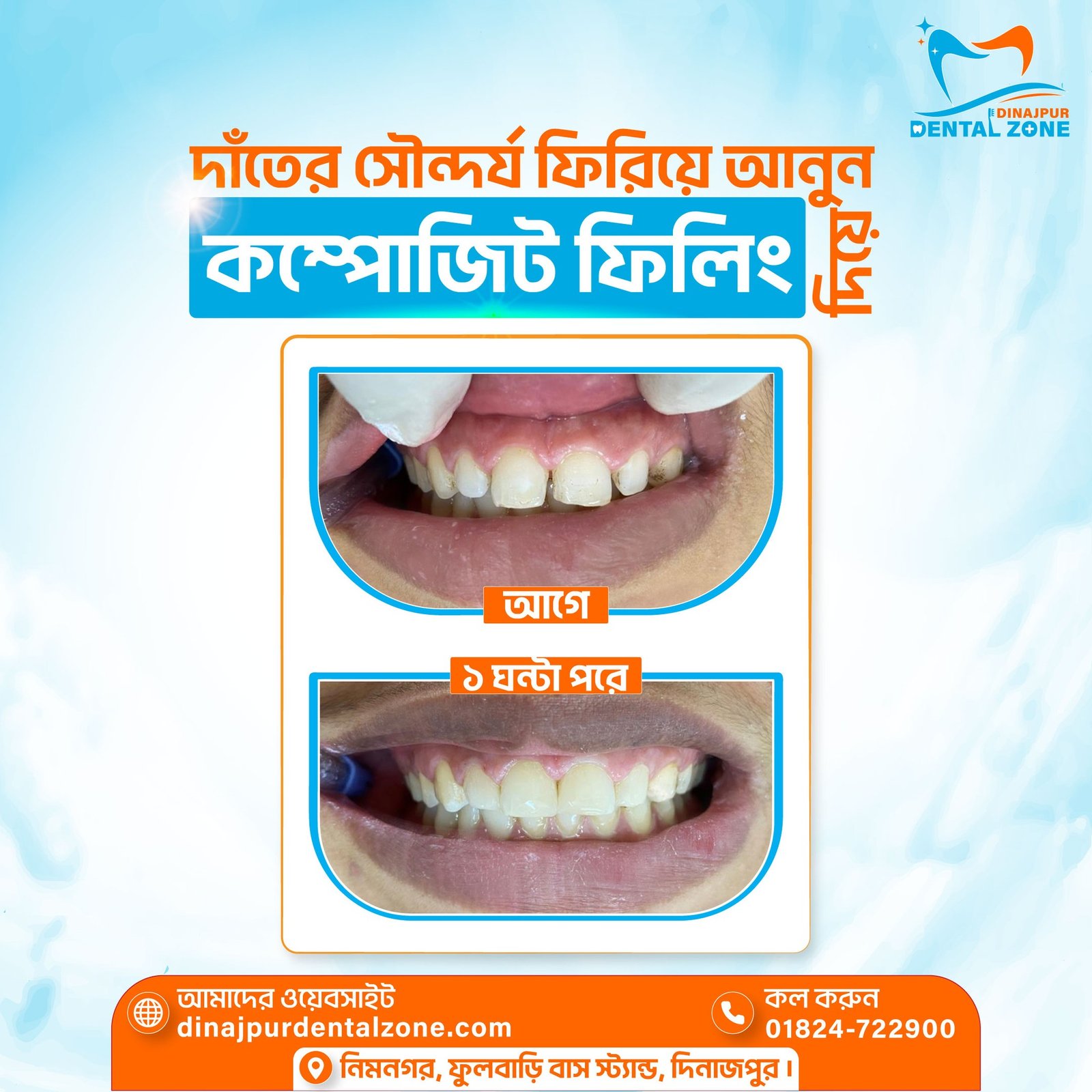 composite venner cosmetic dentistry in dinajpur by Dr. Monjur Alam